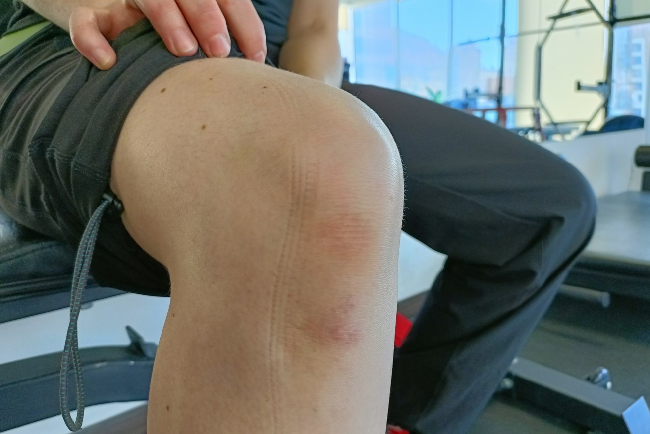 Lesiones de rodilla: Cómo enfrentarlas y prevenirlas  