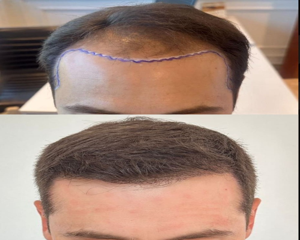 Implantes capilares: el tratamiento definitivo contra la alopecia