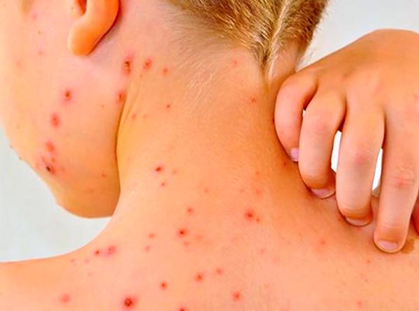 Minsal refuerza alerta por sarampión: especialistas de la U. de Chile llaman a vacunarse ante aumento de casos en la región