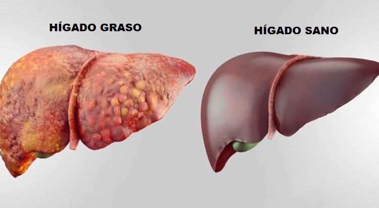 Hígado graso en Chile: la enfermedad silenciosa que afecta a 1 de cada 3 adultos
