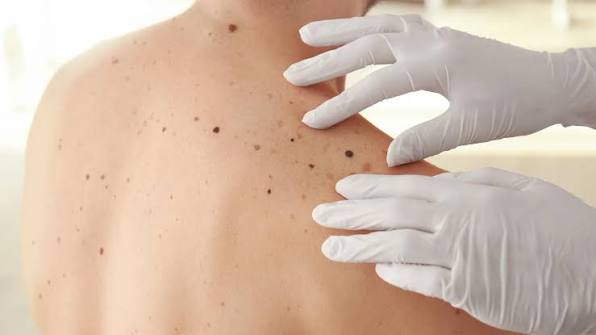 Cáncer de piel: el riesgo continúa durante el invierno